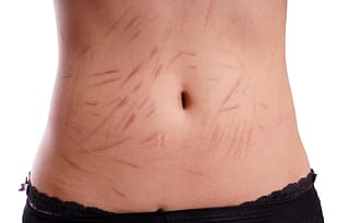 female tummy with scars from deliberate self-harm